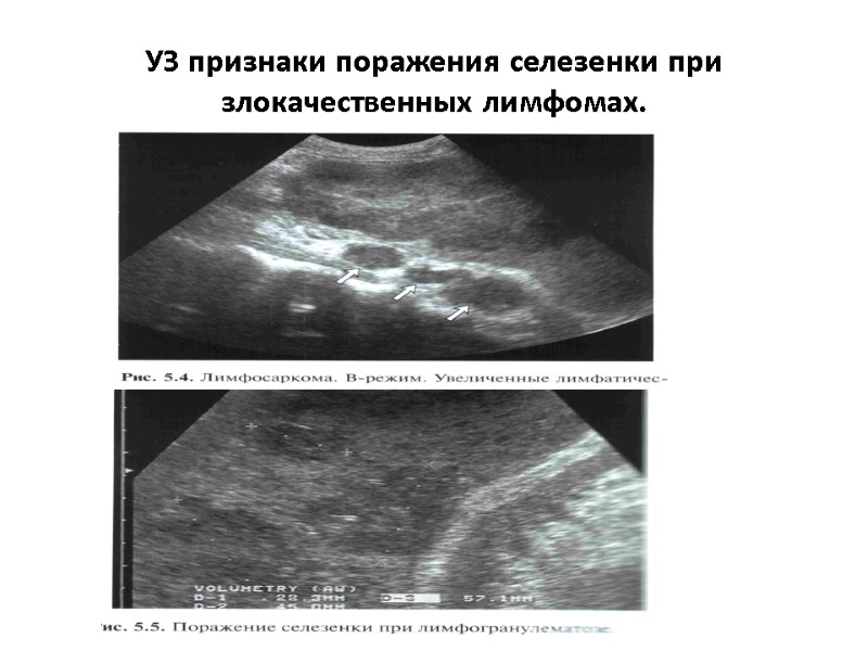 УЗ признаки поражения селезенки при злокачественных лимфомах.